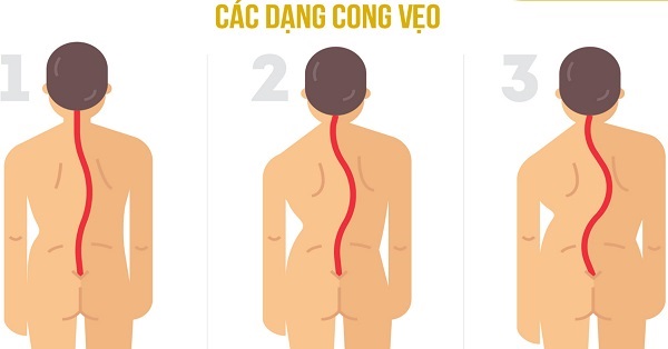 Các dạng của chứng cong vẹo cột sống Các dạng của chứng cong vẹo cột sống